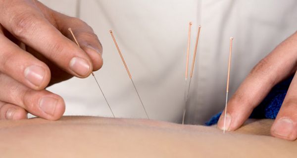 Akupunktur-Nadeln werden in die Haut gestochen