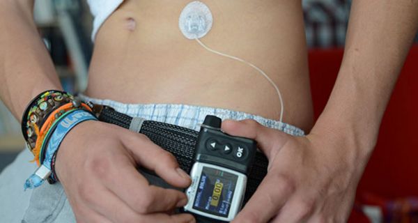In den letzten Jahren nutzen immer mehr junge Typ-1-Diabetiker eine Insulinpumpe.